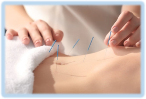 acupuncture1